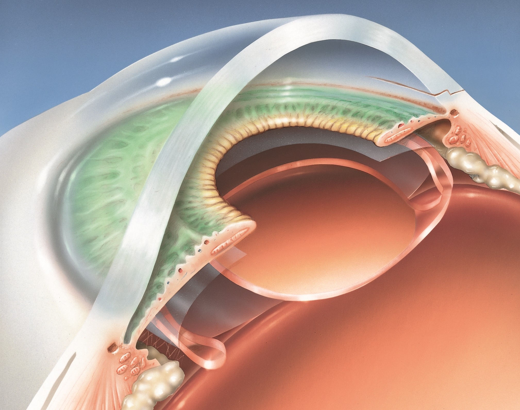 Lasik surgery for cataracts