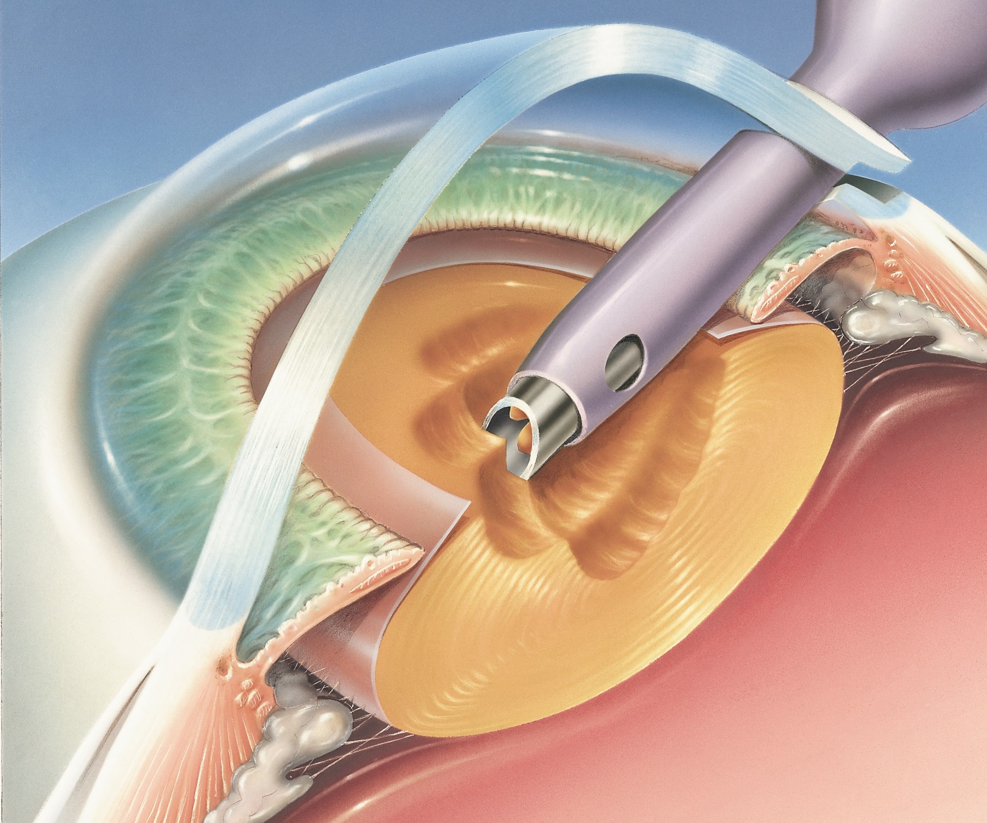 Global Period For Cataract Surgery Calculator