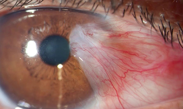 Eye Disease - Applecross Eye Clinic