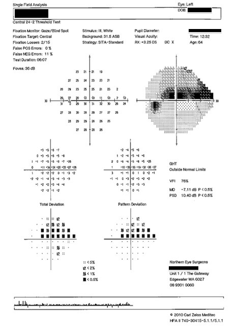 VISUAL TEST OF PATIENT WITH GLAUCOMA - Applecross Eye Clinic