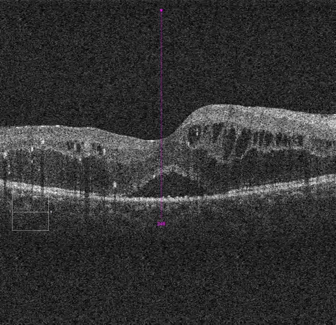 abnormal oct eye test