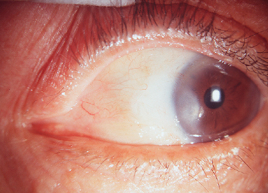 pterygium removal