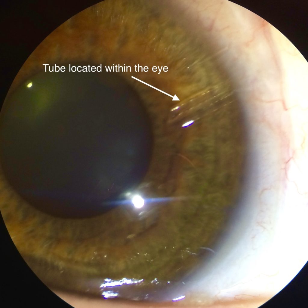 Tube Surgery4 Applecross Eye Clinic